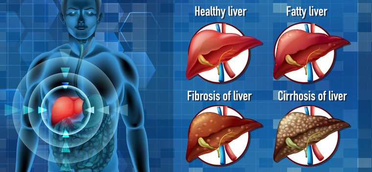 Fatty Liver: 4 Benefits of Consuming Right Diet
